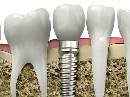 Titanium dental implants Titanium dental implants